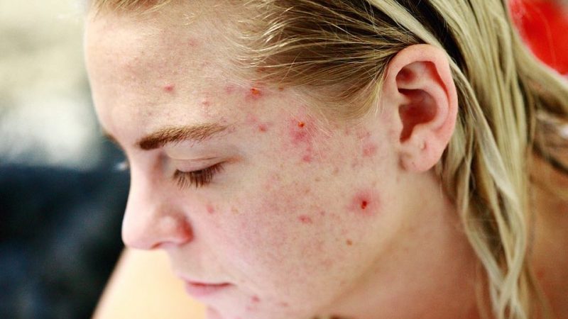 Le psoriasis c’est quoi ?